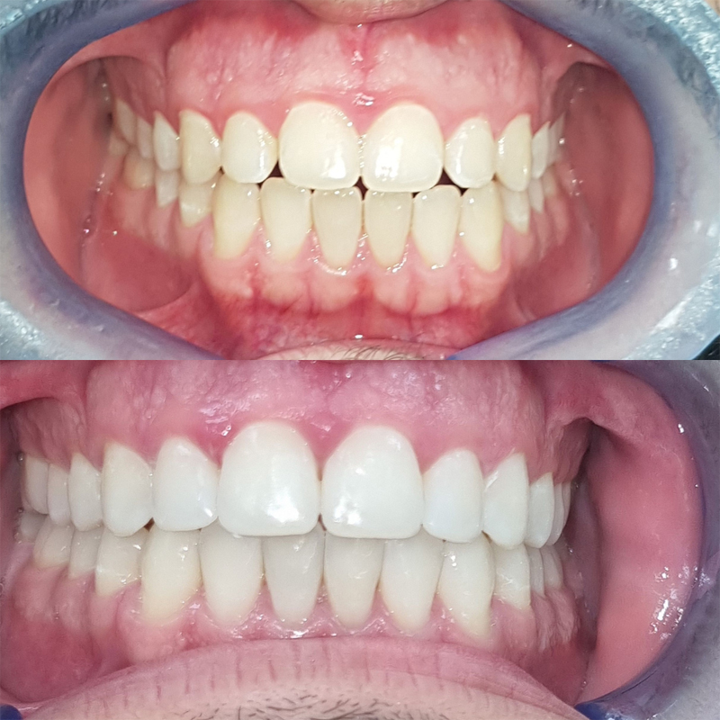 invisalign before after