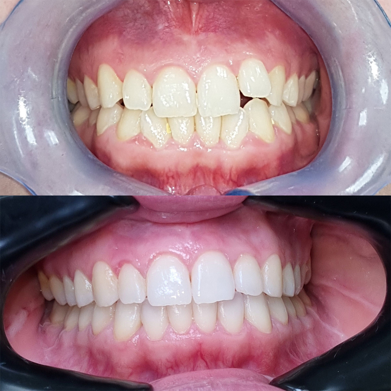 invisalign before after