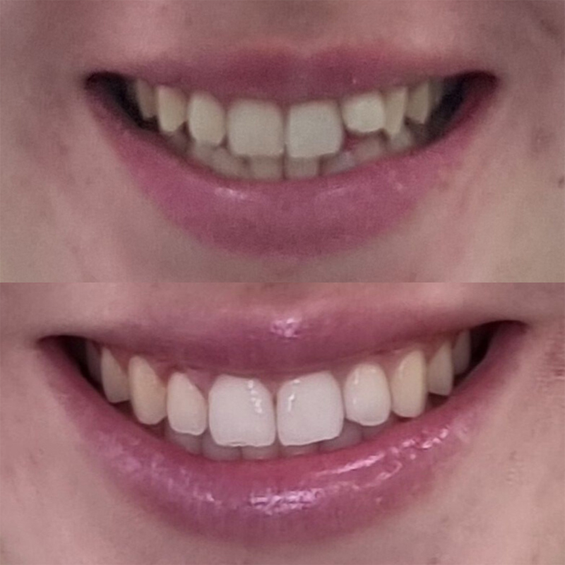 invisalign before after