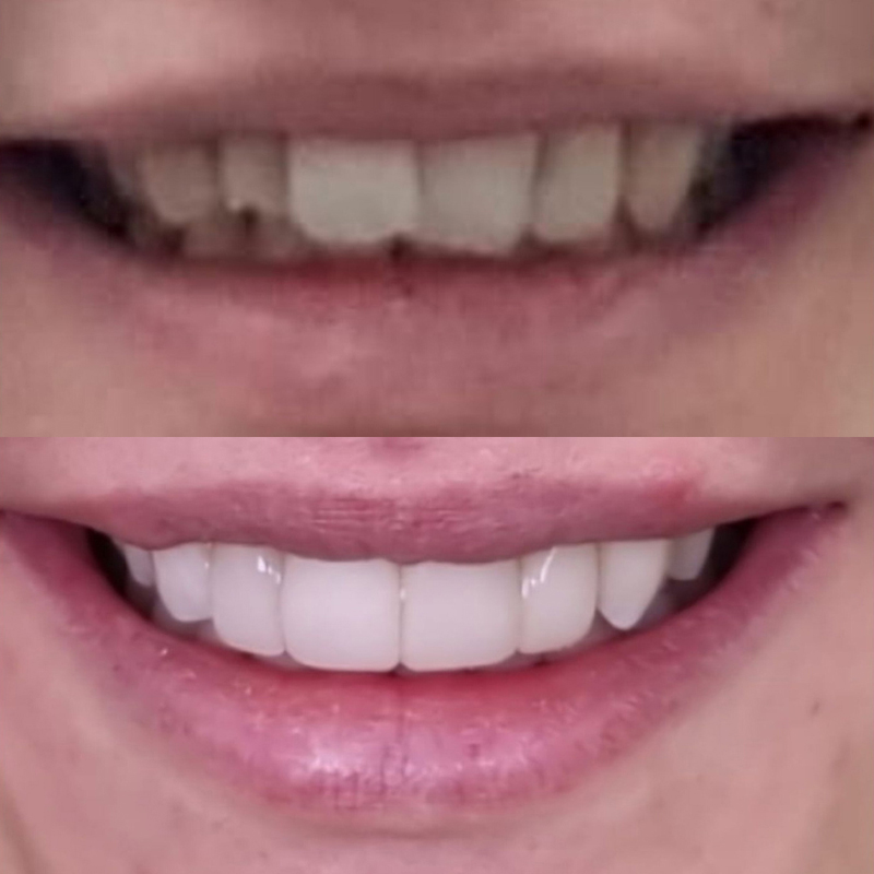 invisalign before after