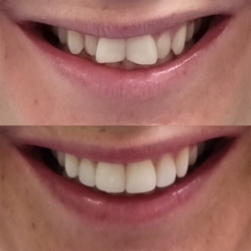 invisalign before after